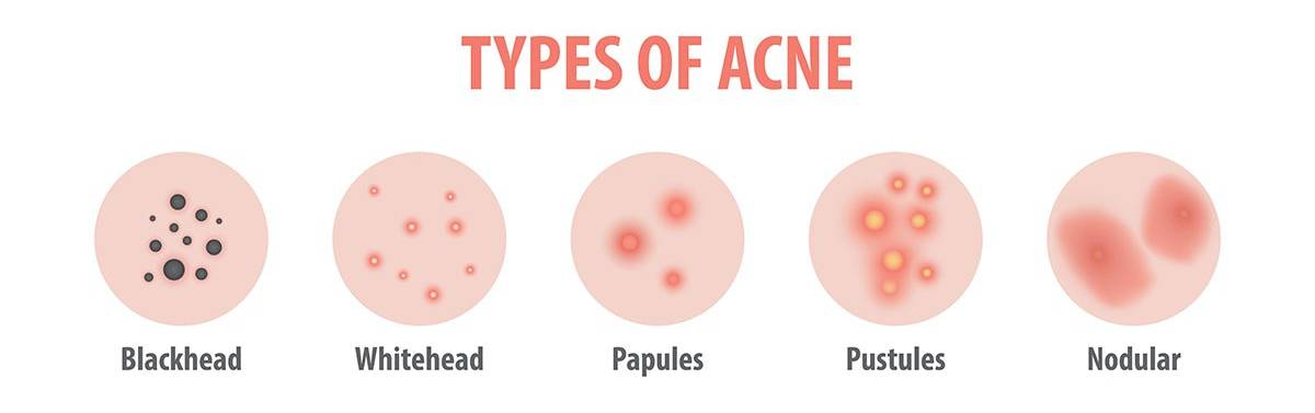Dr. Yeung Ho Hong(楊浩康) explains acne
