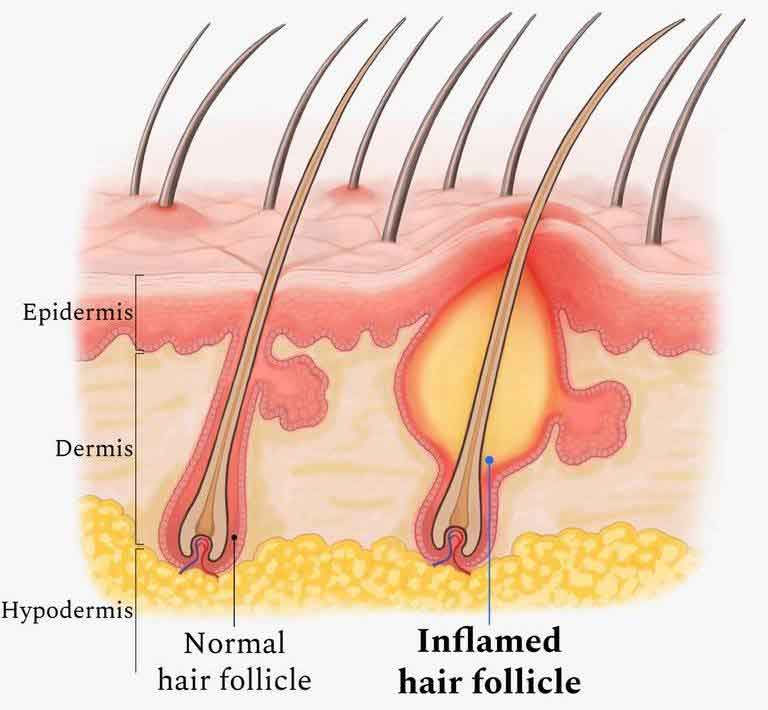 Dr. Yeung Ho Hong(楊浩康) explains Folliculitis? What Causes Folliculitis?