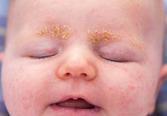 Dr. Yeung Ho Hong(楊浩康) explains seborrhoeic eczema?